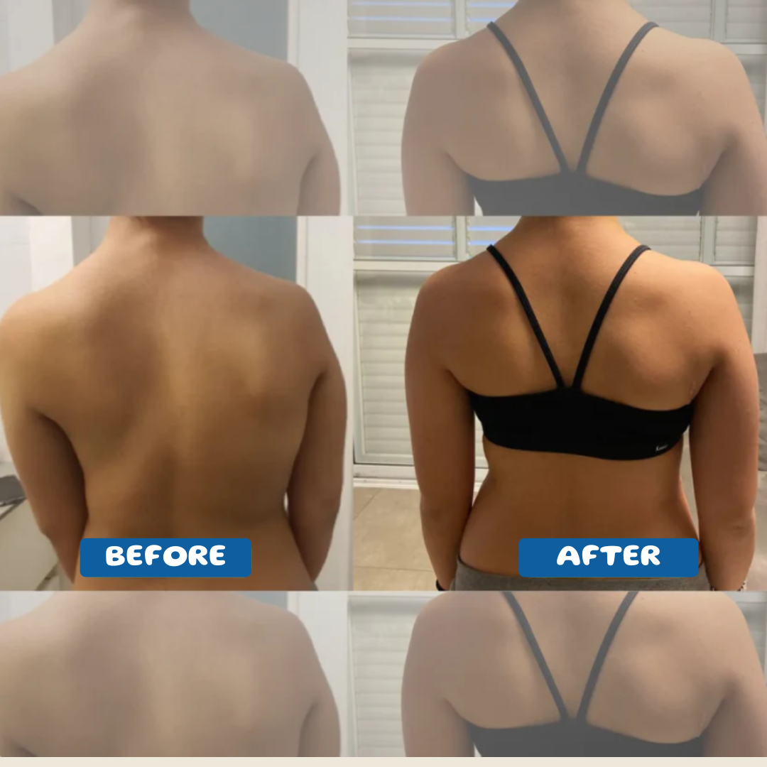 Adjustable Posture Corrector